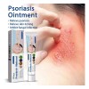 Pomada Psoriasis Natural Antipicazón Hongos Efectiva 20g
