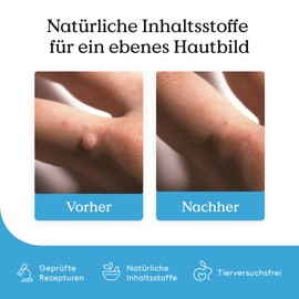 Health Routine Wart Care Pen 3er Pack — Warzenpflege Stift with Teebaumöl, Salicylsäure, and Rizinusöl for Skin Care