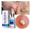 Serum Skin Care Elimina Acné Granos Espinillas Piel Facial F