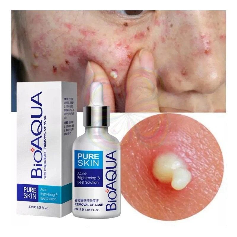 Serum Skin Care Elimina Acné Granos Espinillas Piel Facial F