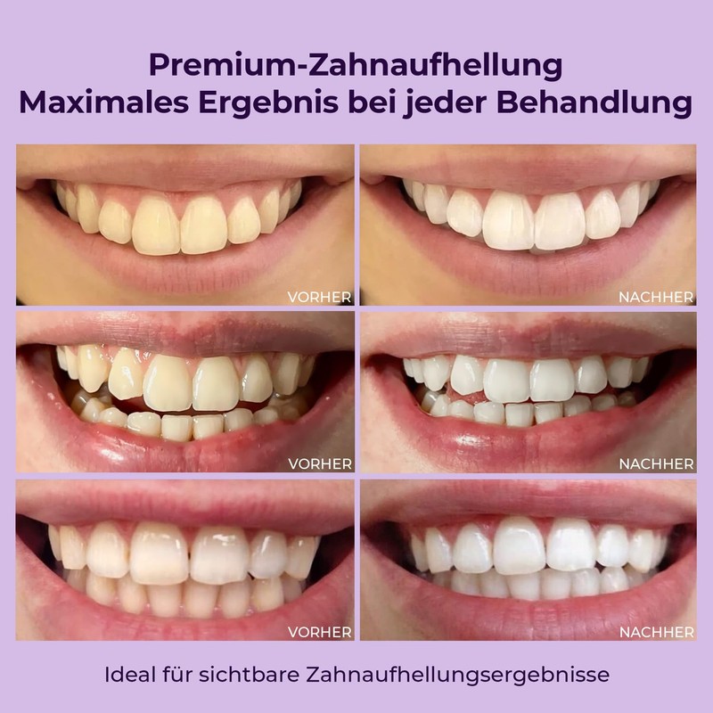 OnlySmile Teeth Whitening Gel for White Teeth | Teeth Whitening