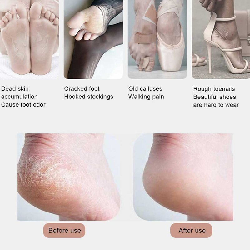 MARSKE Electric Feet Callus Removers Grinder Portable Foot File Pedicure