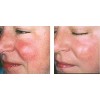 Vitamin K Cream - Eliminate Spider Varicose Veins Rosacea Capillaries