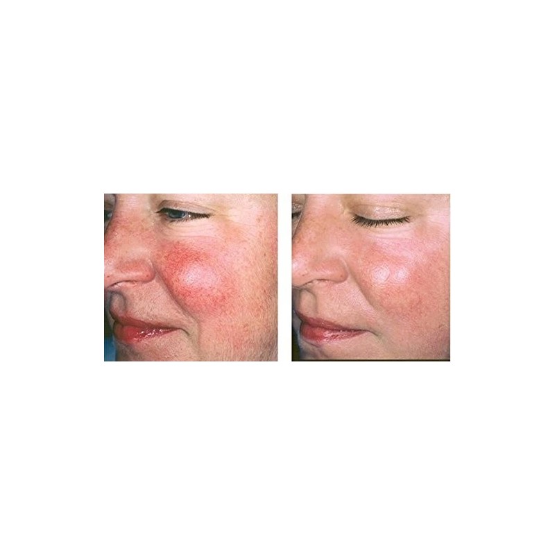 Vitamin K Cream - Eliminate Spider Varicose Veins Rosacea Capillaries