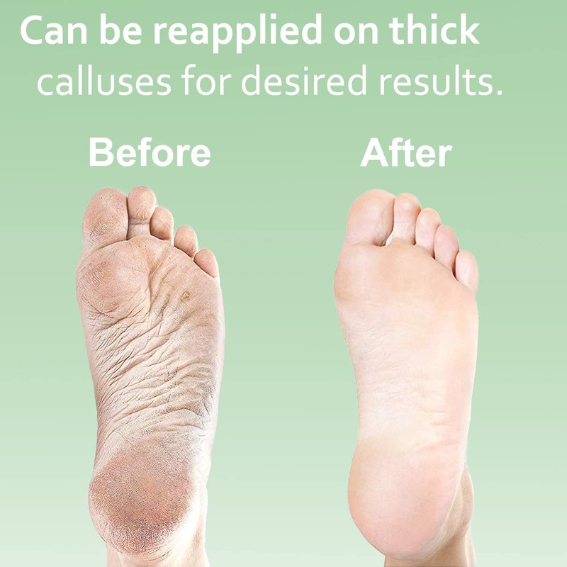 Dr. Entre's Callus Remover Gel & Foot File: Extra Strength