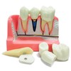 Windplusya Dental Implant Model 4 Times Implant Teeth Model, Analysis