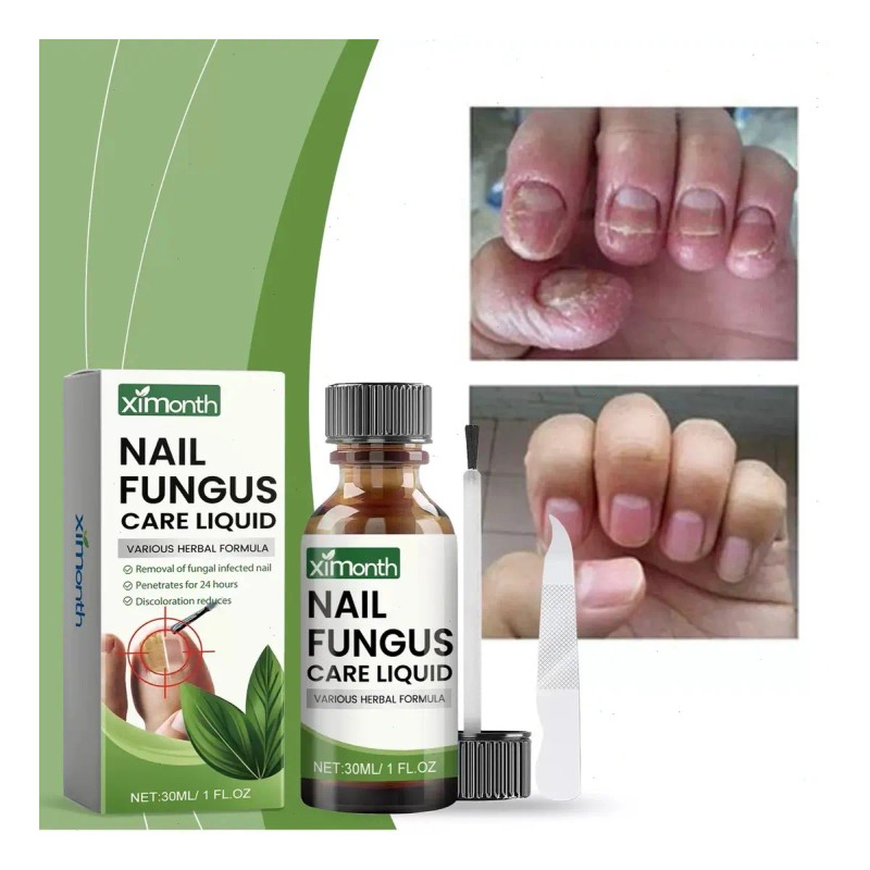 Líquido Para Hongos En Uñas - Cura Hongos Y Onicomicosis