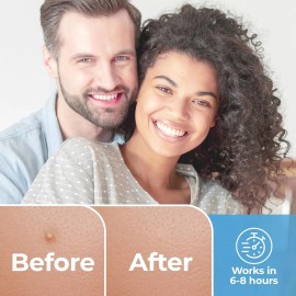 Parches Para Espinillas Para La Cara (paquete De 120), Parch