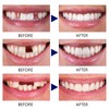 Tooth Repair Kit, Moldable False Teeth, Tooth Replacement Missing Teeth,