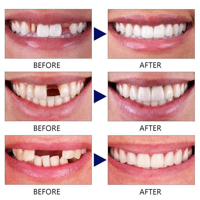 Tooth Repair Kit, Moldable False Teeth, Tooth Replacement Missing Teeth,