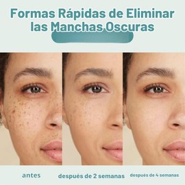 CITYGOO - Eliminador de manchas oscuras para el rostro y cuerpo: crema correctora de manchas oscuras con ingredientes naturales y efectivos para una p