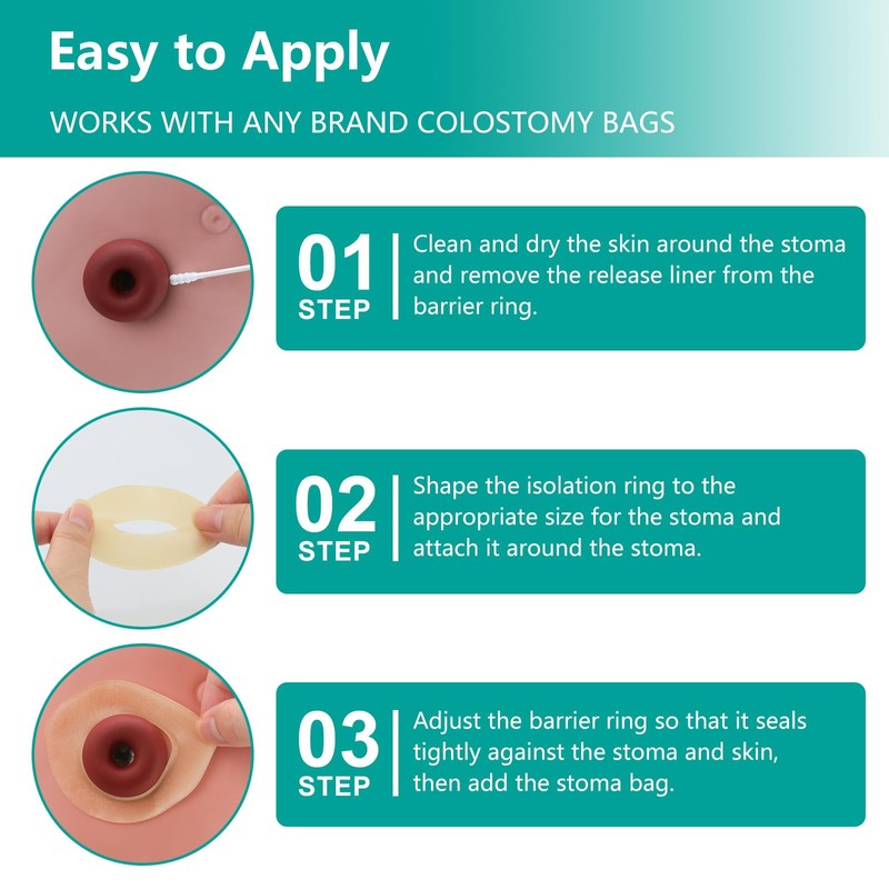 Ostomy Barrier Rings - Outer Diameter 2" (50mm) 4mm Thickness,Moldable