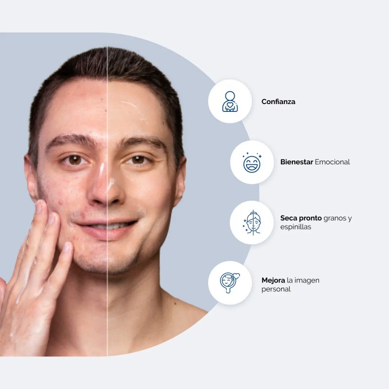 Gel Peróxido de Benzoilo 5% para Acne - Bpollen 60