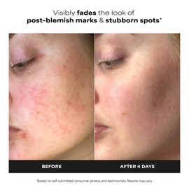 Paula’s Choice BOOST 10% Azelaic Acid Booster Cream Gel, Oil-Free Serum Fades Discoloration & Post-Blemish Marks, with Licorice Extract & Salicylic Acid, Fragrance-Free, 1 Fl Oz