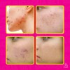 Set Pure Skin Bioaqua Retira Acne Espinillas Grasa Mixta