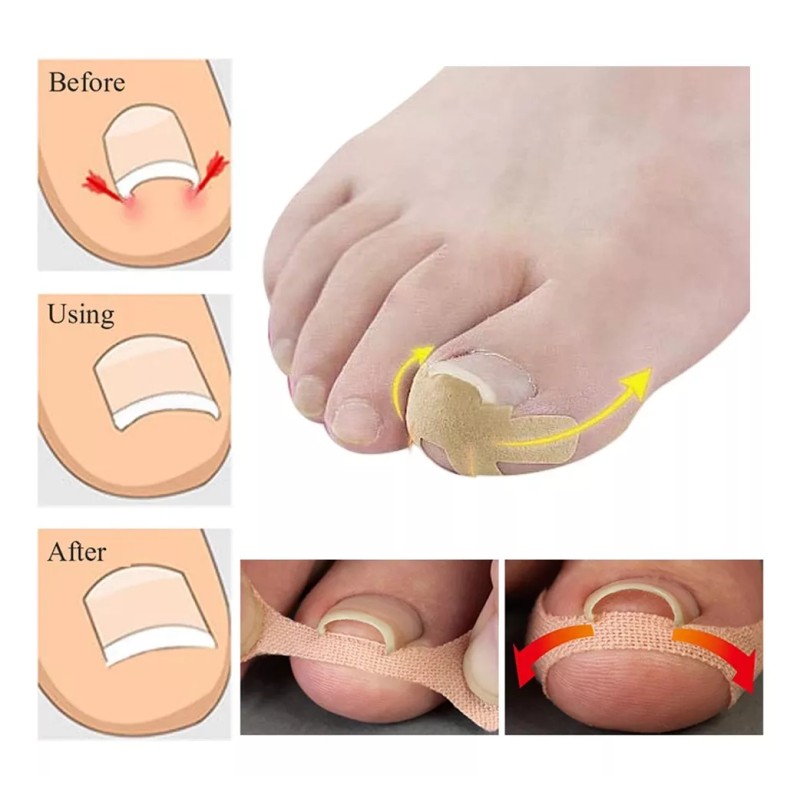 Dolores Kit Pedicure Corrector Uña Tratamient Enterradas Herramienta