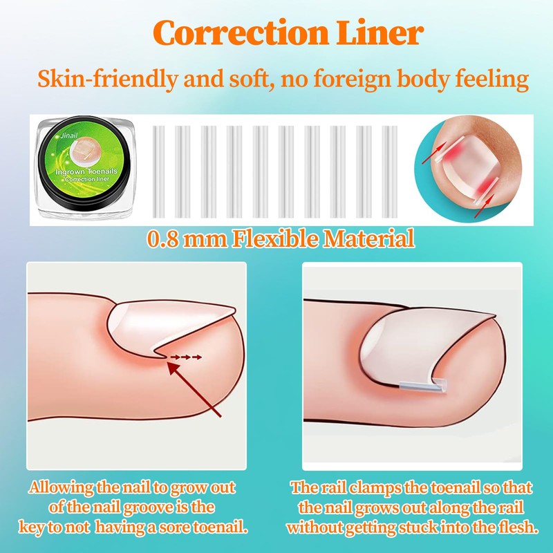 Ingrown Toenail Tool Set, Corrector Pedicure, Ingrown Toenails Set, 30