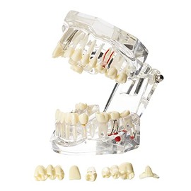 Modelo de tipodonto oral dental implante patológico extraíble enseñar demostración de anatomía visible tamaño estándar (transparente)