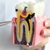 Dental Caries Teeth Model, 3.4 x 3 x 2 Inches
