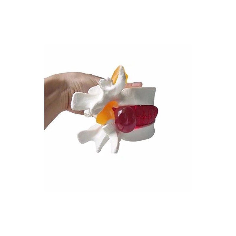 BoNew 1:1.5 Anatomical Human Lumbar Vertebrae Degenerative Lumbar Human Spine