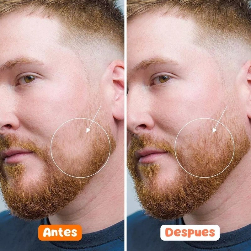 Veraly Rodillo Micro Agujas Dermaroller Crecimiento Pelo Barba