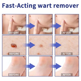 SarMee Skin Tag Removal Kit, Wart Removal Pen 3ML, Skin Tags Remover, mole, Calluses on Body (3)