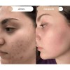 Crema Facial Hidratante Dermoaclaradora Reparadora Anti Acne Día/noche Todo Tipo