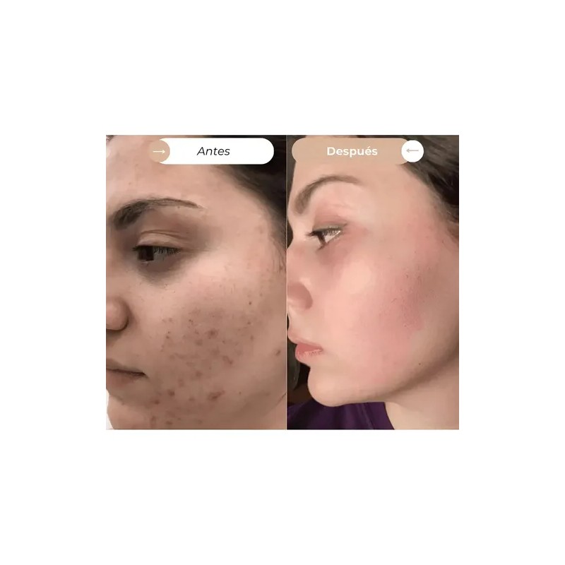 Crema Facial Hidratante Dermoaclaradora Reparadora Anti Acne Día/noche Todo Tipo