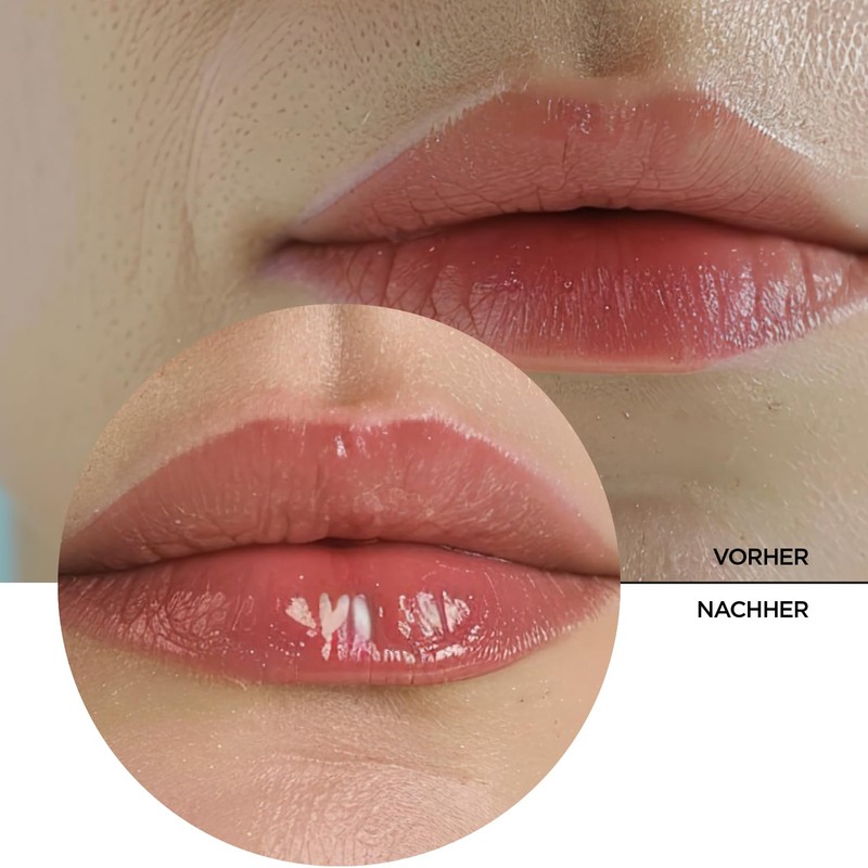 REVOX B77 Lip Filler Hyaluronic Acid 12 ml