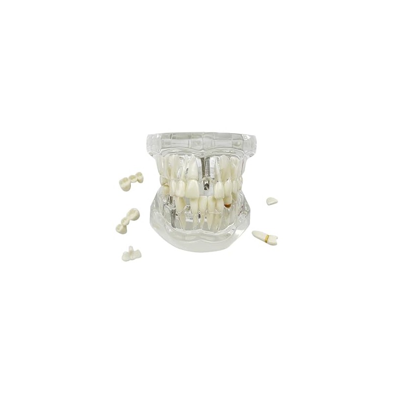 Modelo de implante de dientes, para enseñanza, modelo de enfermedad,