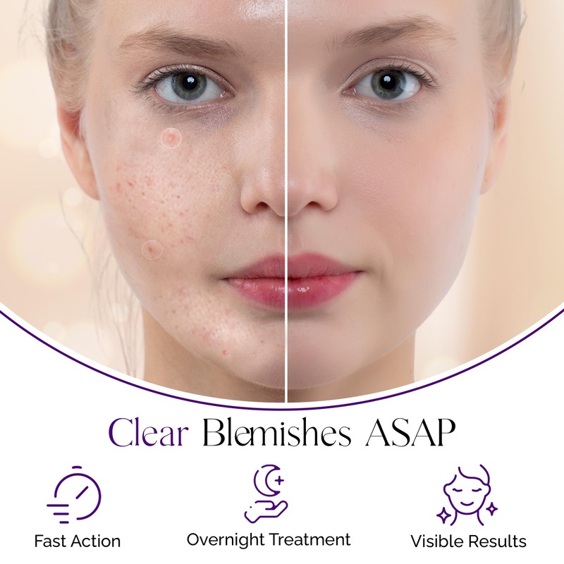 Pimple Patches for Face - Set of 36 Hydrocolloid Pimple