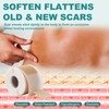 Silicone Scar Sheets, Silicone Scar Tape(1.6"x 158"), Scar Tape for
