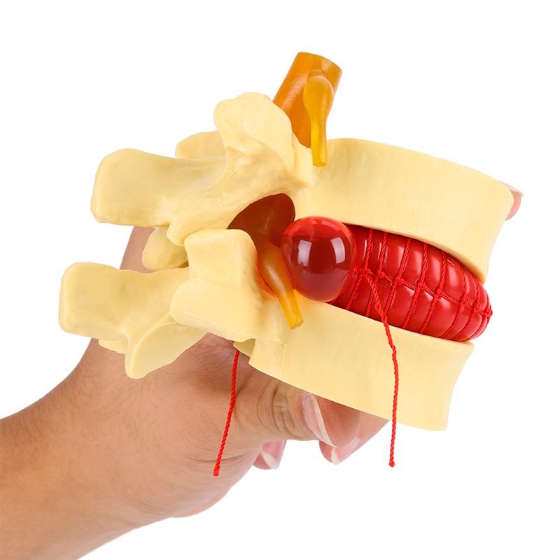 1:1.5 Anatomical Medical Human Spine Lumbar Disc Herniation Demonstration Model