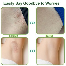 XUJECT Ingrown Hair Solution -Bikini Area Exfoliating Body Scrub,For Razor Bumps For Women And Men 、Armpit Whitening、Armpit Detox,8.8 Oz - 1 pcs