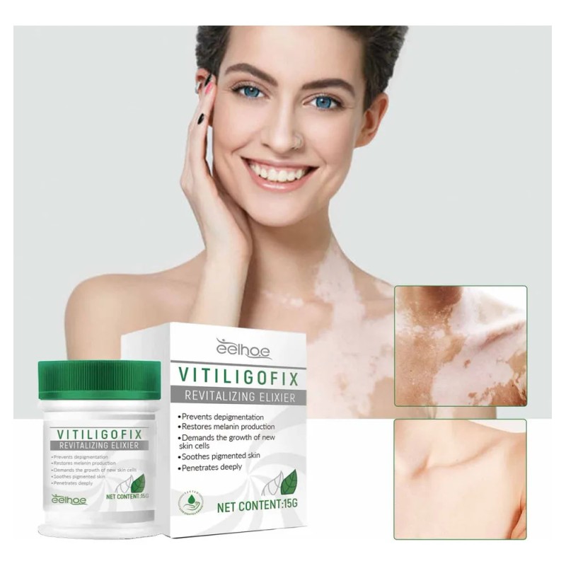 Crema Uv White For Vitíligo, Aceite De Vitíligo Localizado