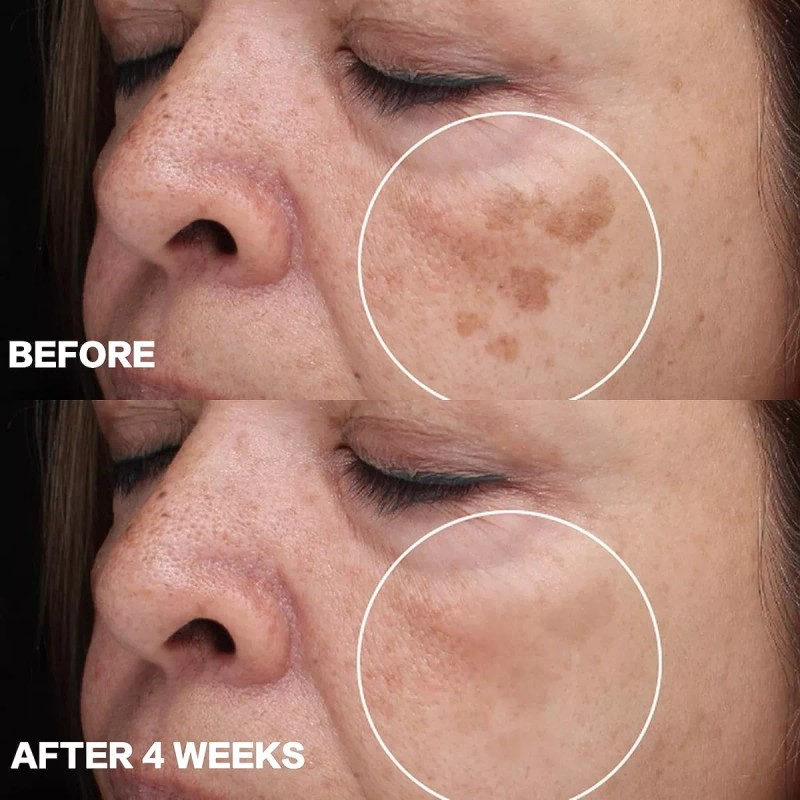 Citygoo Eliminador De Manchas Oscuras Para La Cara: Crema Co