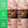 ACOTYE Pimple Patches, 245 Pieces, Acne Patches, Acne Patches, Tea
