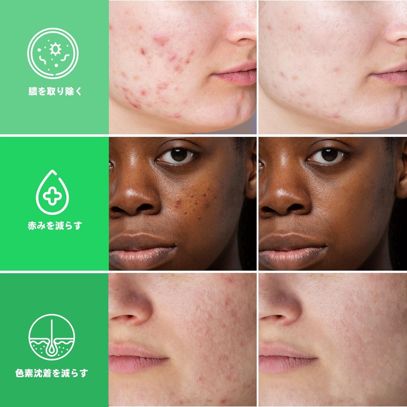 ACOTYE Pimple Patches, 245 Pieces, Acne Patches, Acne Patches, Tea