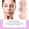 Ouhoecrema Facial Cuidado Acné Ácido Azelaic