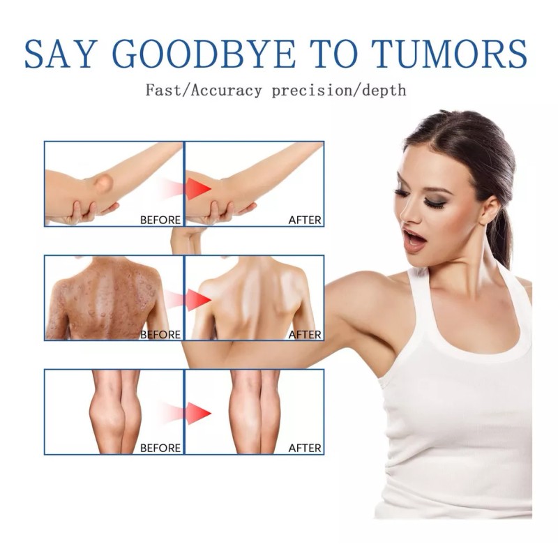 Generic 2× Crema De Eliminación De Lipomas Q Lipoma Cleaning