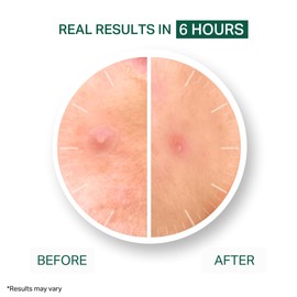 Y'OUR Healing Acne Patches, Hydrocolloid Pimple Patch for Face, Purifies & Alleviates Stubborn Blemish, Promotes Healing, Zit Effective Treatment, 56 Count