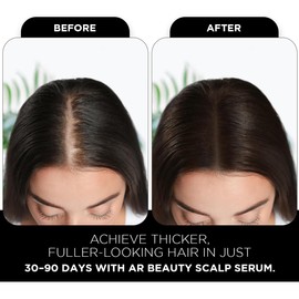 Scalp Hair Growth Serum by ARBEAUTY – Advanced Hair Growth for Women & Men With Rosemary & Biotin-Anti Dandruff & Anti Hair loss -Helps To Get Thicker & Fuller Looking Hair -Smell Free, 1 fl. oz.