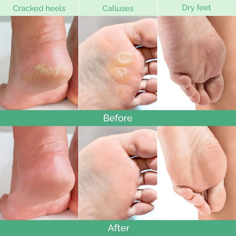 Mascarilla Peeling Para Pies - Extracto De Melocotón + Aloe