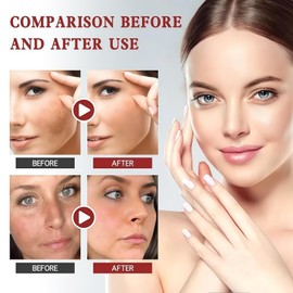 Dark Spot Remover Face Creams,Dark Spot Remover for Face & Body,Pigmentation Treatment,Age Spot Cream,Whitening Freckle Cream,Sun Spots and Melasma Treatment Creams,Fade Freckles & Improve Dull Skin