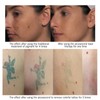 Handheald Red Light Picosecond Laser Pen Scar Tattoo Removal Melanin