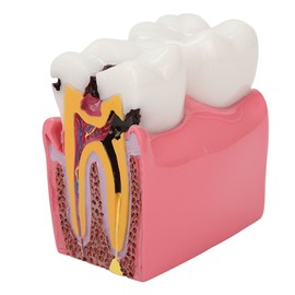Dental Caries Model Tooth 6X Decay Demonstration Model for Teaching Study Laboratories