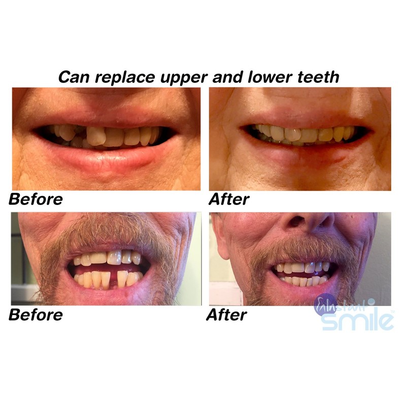 Instant Smile MULTISHADE Patented Temporary Tooth Repair Kit. A Realistic