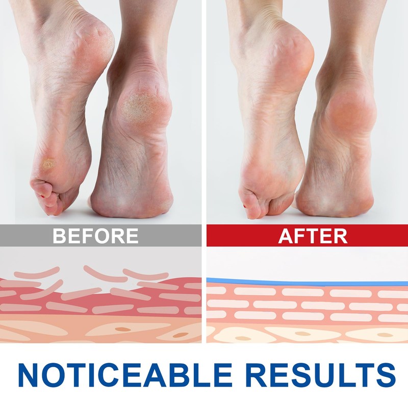 2 pieces urea cream, 60% urea cream, 60% foot care