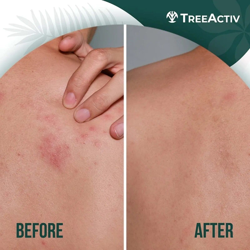 Treeactiv Gel Corporal Exfoliante Para Acné Espalda Glúteos