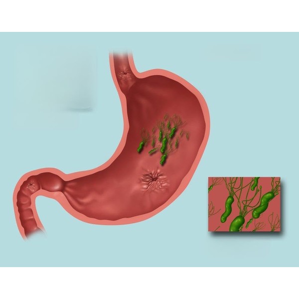 Posterazzi GLP469052LARGE Poster Print Collection Helicobacter Pylori Infection Illustration Poster